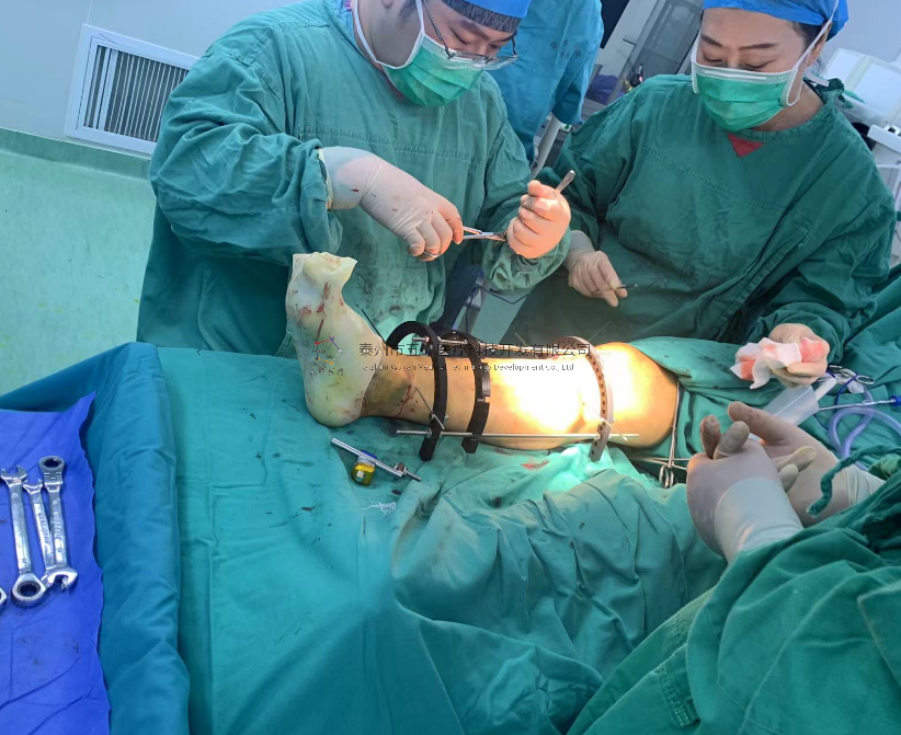 【望京醫(yī)院】不開刀治骨折病例分享——脛骨遠(yuǎn)端骨折腓骨骨折 【望京醫(yī)院】不開刀治骨折病例分享——脛骨遠(yuǎn)端骨折腓骨骨折